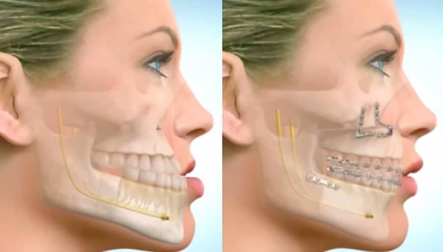 جراحی فک یا ارتودنسی؟ کدام‌یک برای اصلاح لبخند شما حیاتی است؟